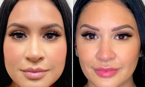 6489fab093578730b39d4fcd_Jawline-Masseter-Botox-1