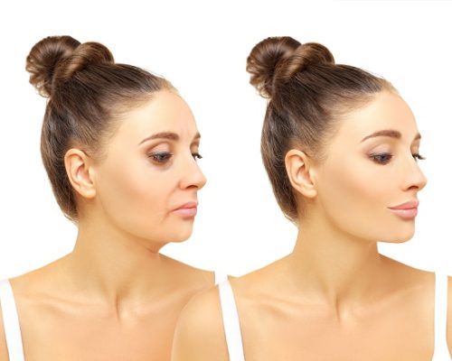 Before-after-overall-aging