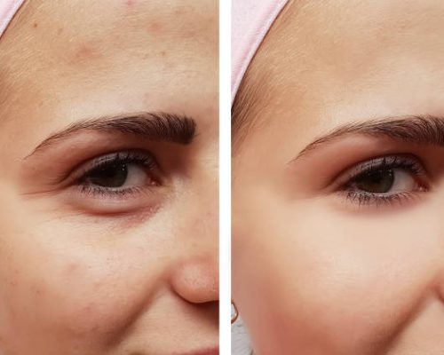 beautiful girl face wrinkles before and after procedures