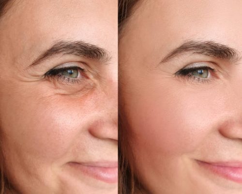 woman face wrinkles before and after treatment collage