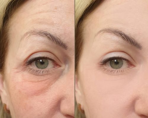 woman face wrinkles before and after treatment